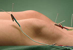 Stimulationsgeräte in der Akupunktur